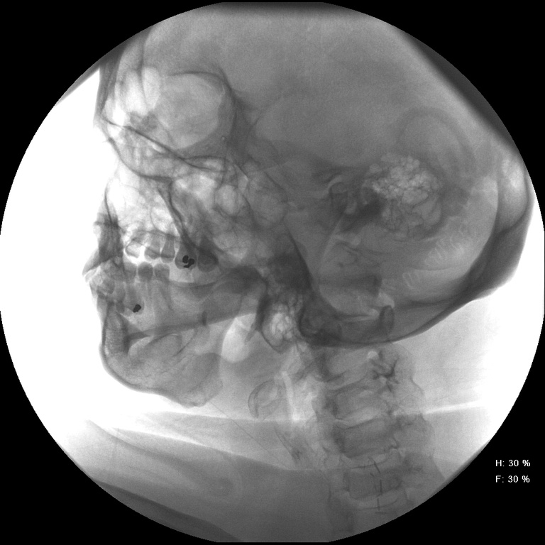 Normal clearing of contrast after catheter remoavl and lemon drops