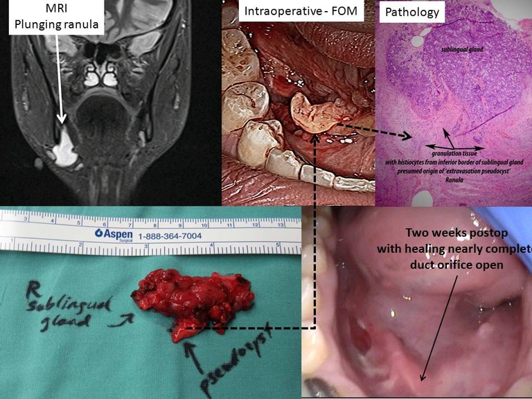 Preop MRI; intraoperative resection; histopathology and gross appearance of resected gland; postop 2 week image of floor of mouth