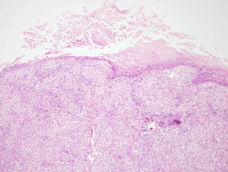 This biopsy shows a keratotic surface crust with a vaguely nodular submucosa expansion at low power. In this case, the abnormality appears to be going from the bottom up, rather than the top down, as is often observed with neoplasia.