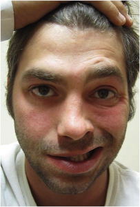 Bell's Palsy (image property of Wikimedia commons)