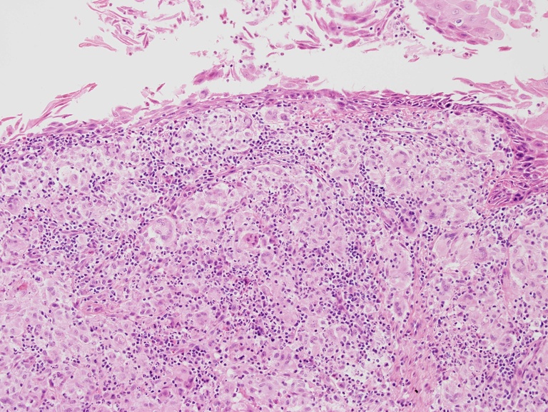 An intermediate power view reveals a dense giant cell infiltrate with back to back epithelioid histiocytes and conspicious neutrophilic infiltrate
