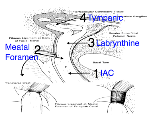 Intratemporal facial nerve anatomy (image modified from Fisch, Facial Nerve Surgery, 1977)