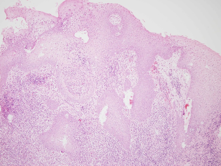 This low power view highlights pseudoepitheliomatous hyperplasia, a reactive phenomenon, overlying the submucosa inflammatory infiltrate. In some cases, this can mimic well-differentiated squamous cell carcinoma.