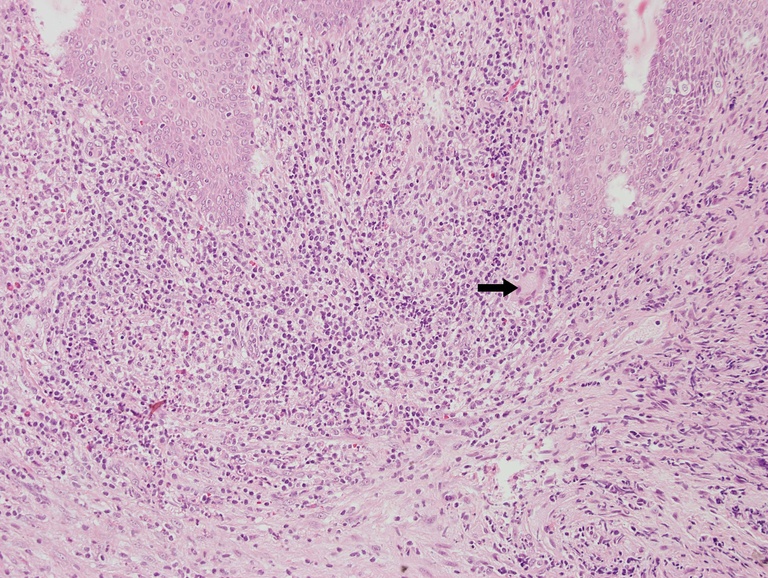 A high power view of pseudoepitheliomatous hyperplasia shows downward epithlelial growth with reactive nuclear changes and overall architectural regularity. A giant cells is shown (arrow).
