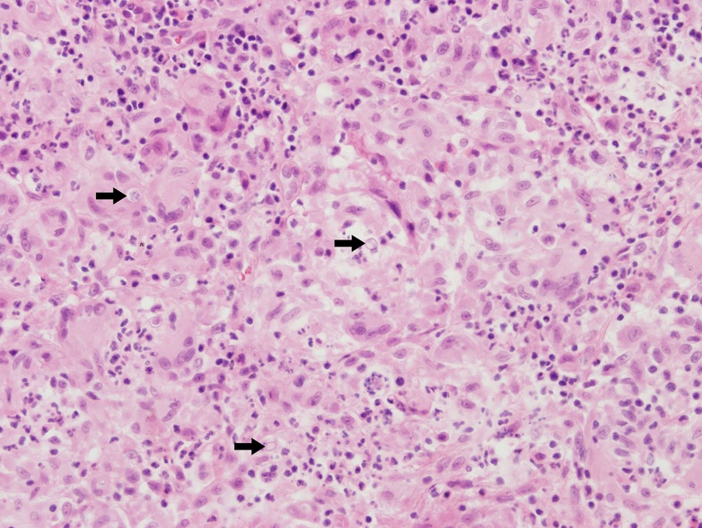 This high power view highlights the morphology of the histiocytes and enables one to see the negative image (arrows) of scattered yeast forms