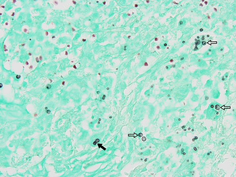 Grocott Methenamine Silver (GMS) stain highlights several yeast that vary in size significantly. Blastomyces has some of the largest yeast forms (hollow arrows) and buds on a broad base (black arrow).
