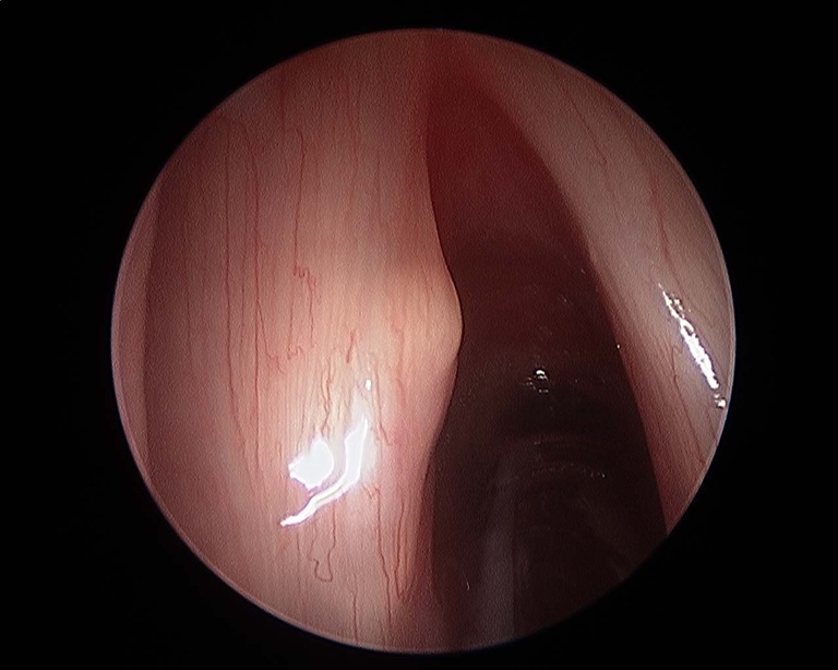 before cyst excisiona.jpg