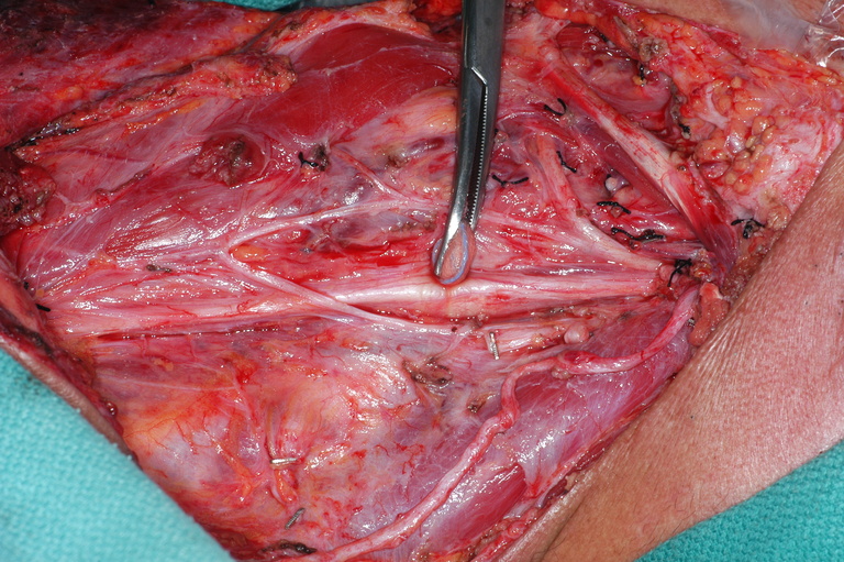 Anatomy of ansa - depicted in a patient following neck dissection
