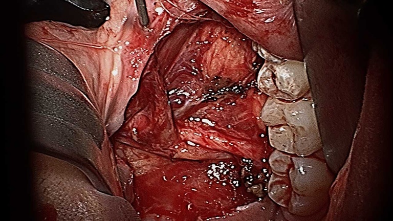unlabelled view of right floor of mouth after sublingual gland resection