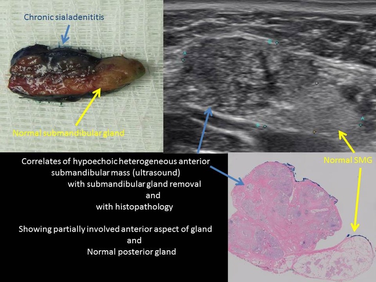 Pathology and ultrasound of Left submandibular gland