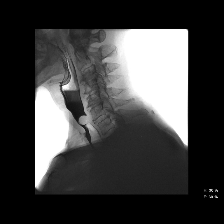 cricopharyngeus%20dysphagia%20062310.jpg
