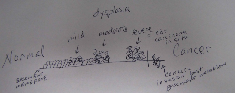 diagram%20of%20dysplasia.jpg