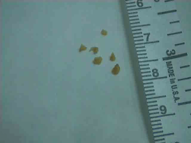 fragments%20of%20stone%20removed.gif