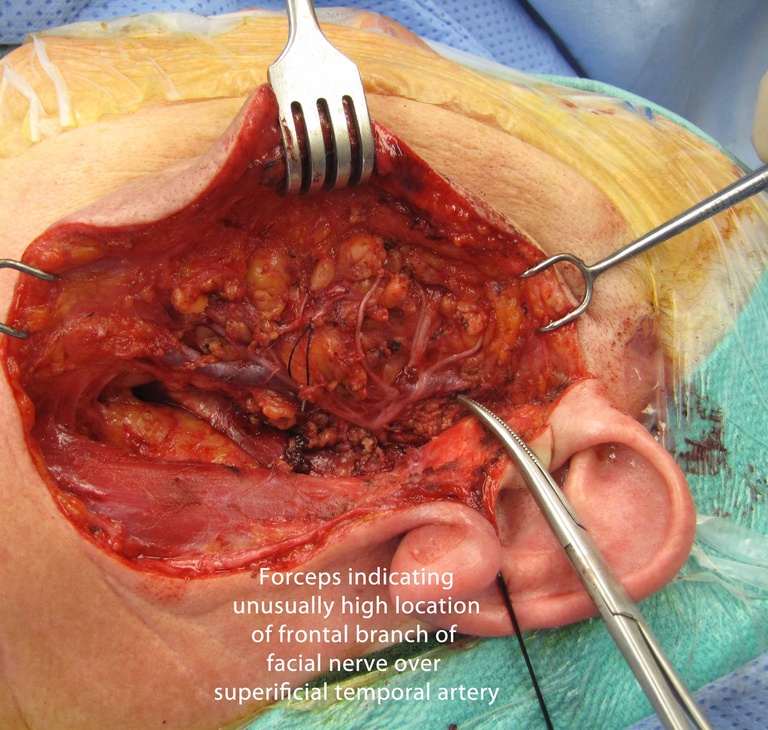 ii.Occasionally, the frontal branch of the facial nerve may cross the superficial temporal artery at an unusually high location as shown