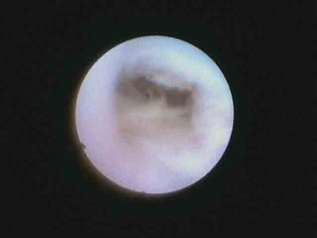 hilum%20after%20stone%20removal%20copy.gif