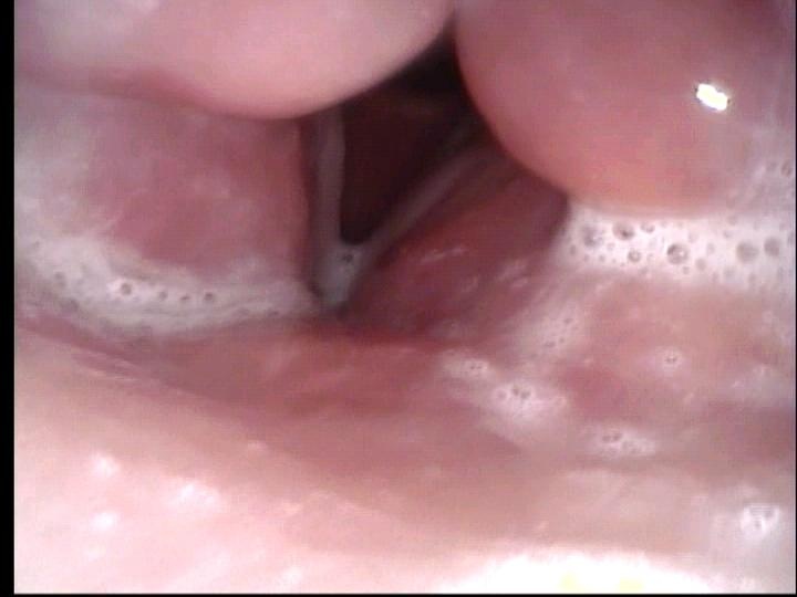Larynx with supraglottic edema from Chemo-XRT