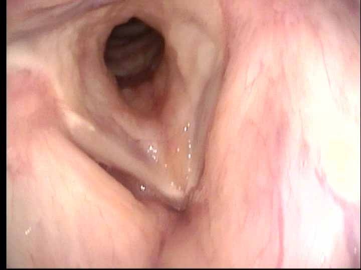11 yr f/u