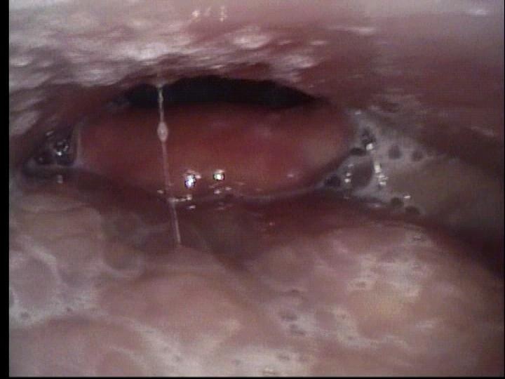 Narrow pharynx consistent with OSAS