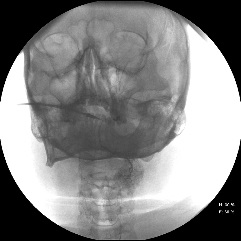PA of SMG with contrast in ductal system