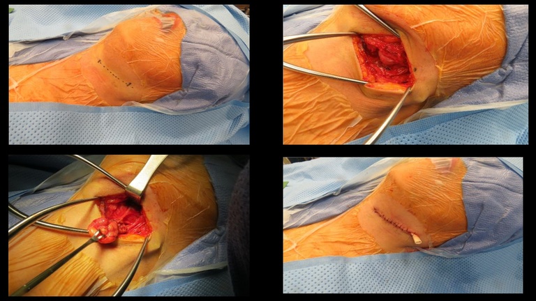 Surgery