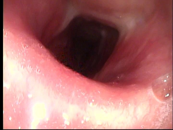  Trach removed with airway improved for sleep study