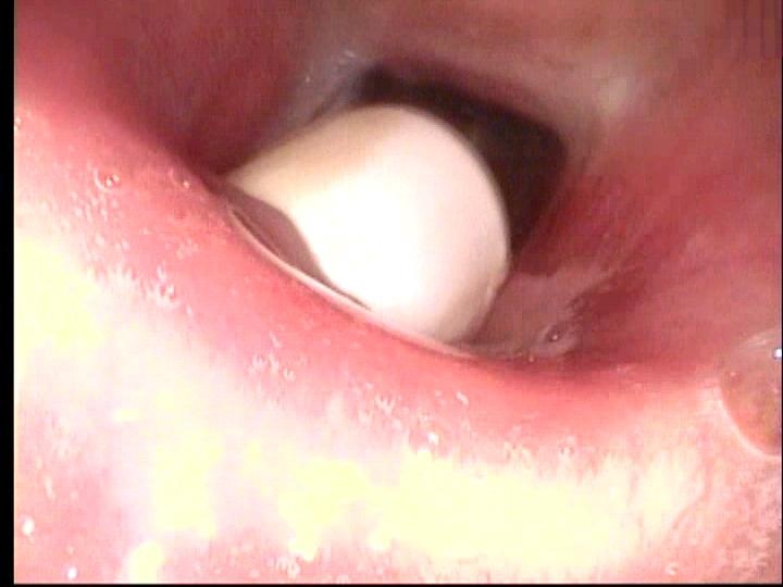 Process of trach removal with airway improved for sleep study