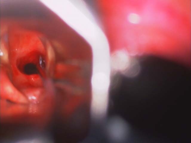 scissors cut before 1200 biopsy.jpg