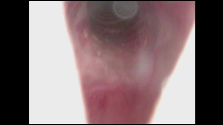 subglottis post-op day 4 following kenalog infusion and dilation