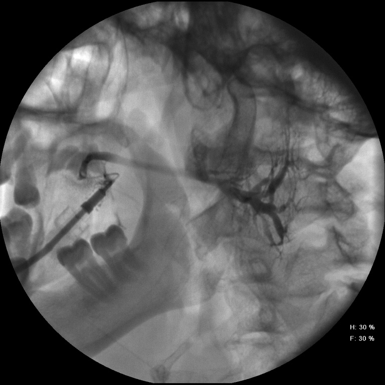 Withdrawl of catheter shows spill of contrast and stone in distal duct
