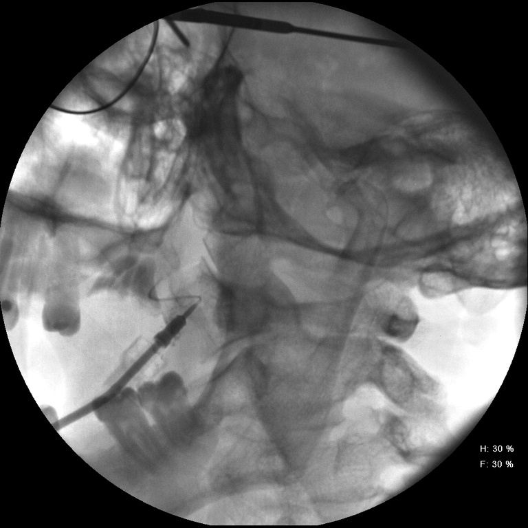 PA view shows dilated ductal system