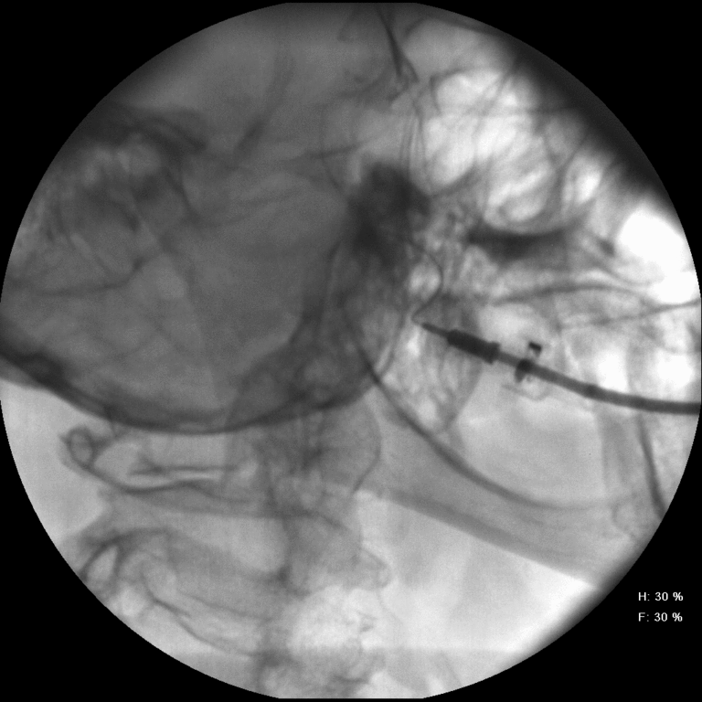 instillation of contrast shows moderate to severe stenosis of duct with multiple focal outpouchings of contrast