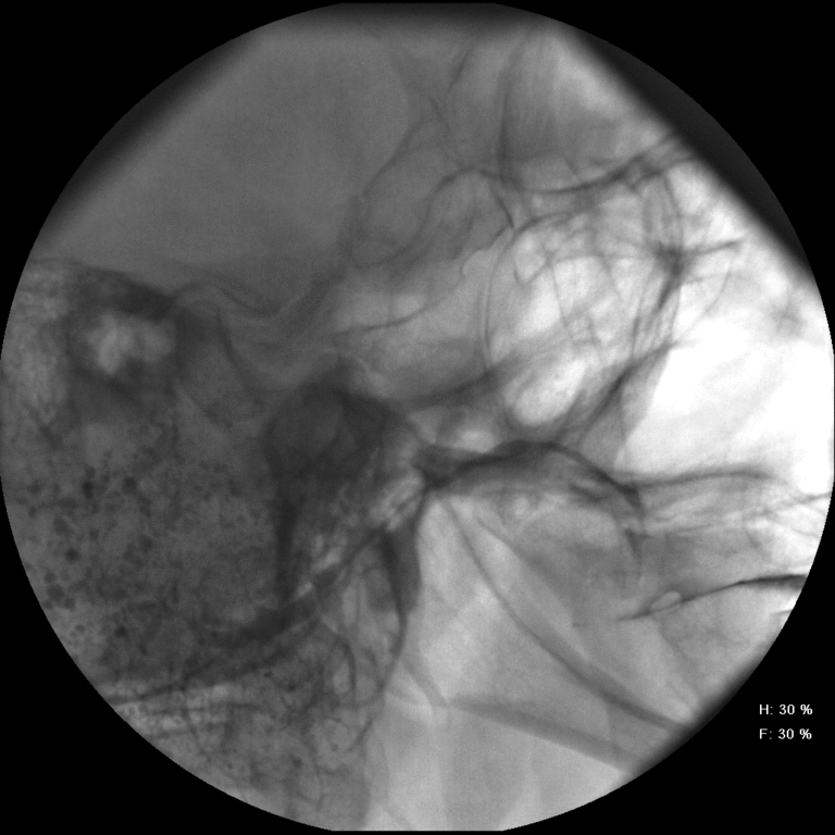 Catheter placed in Stensens duct before instilling contrast