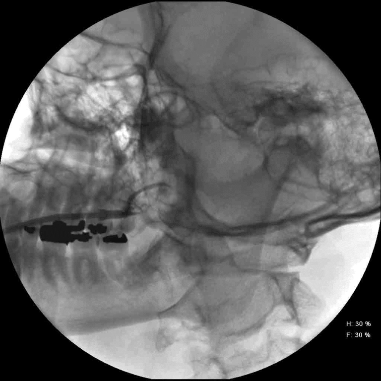 Instilled contrast is unable to pass beyond stricture