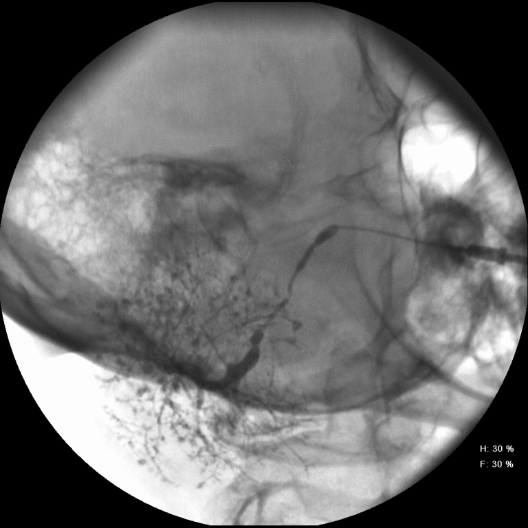 PA view pf dilated acini with ductal strictures