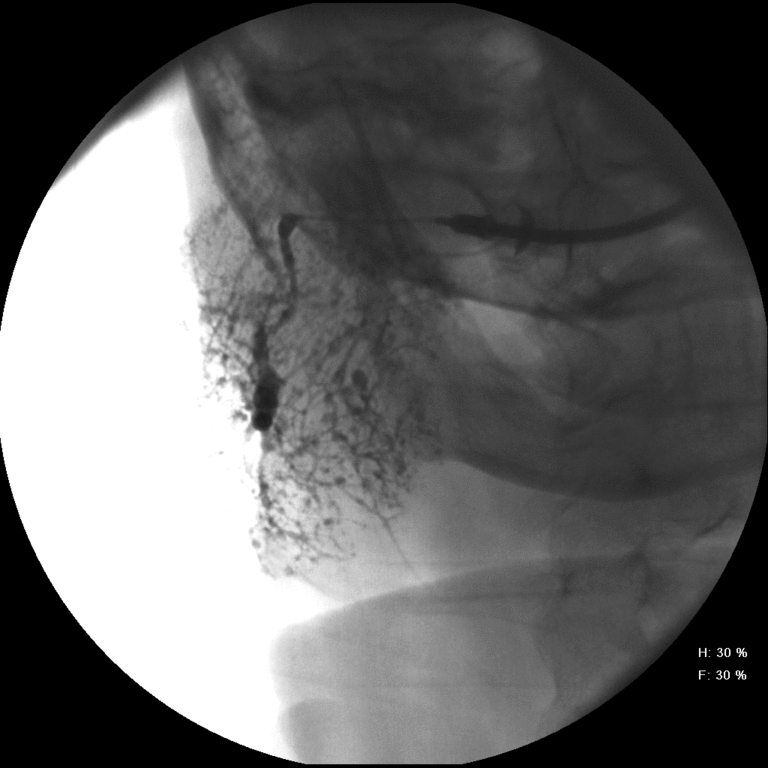 Retained contrast seen after catheter removed and after use of lemon drops