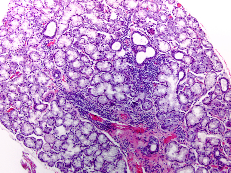 Lobule of minor salivary gland with lymphocytic-predominant foci of chronic inflammation
