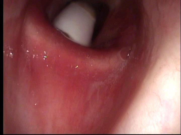 View past vocal cords of subglottis