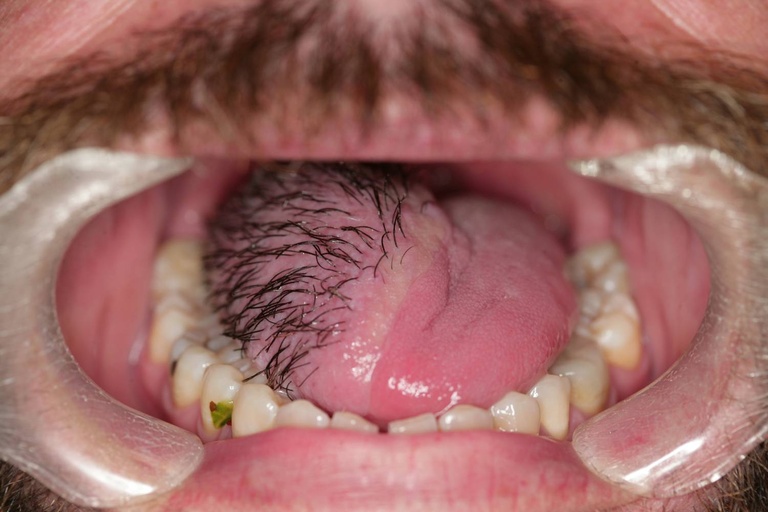 Submental flap 3 months post-operatively,