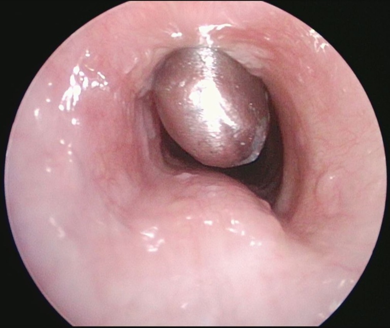 Suprastomal granulation tissue being removed with Kerrison rongeurs