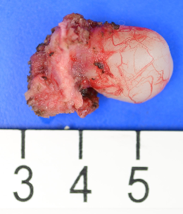 Excised thyroglossal duct cyst