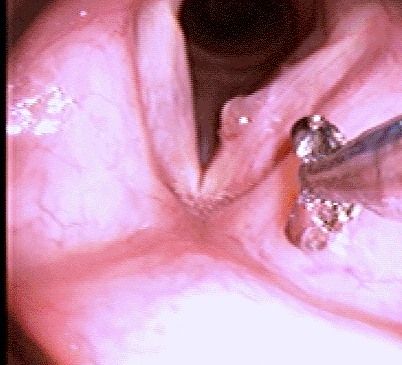 tnepolyp100709a.gif
