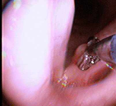 tnepolyp100709b.gif
