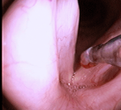 tnepolyp100709c.gif