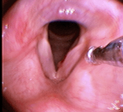 tnepolyp100709d.gif