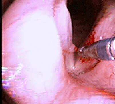 tnepolyp100709e.gif