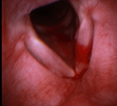 tnepolyp100709f.gif