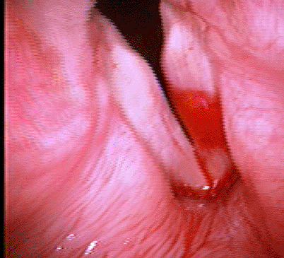 tnepolyp100709g.gif