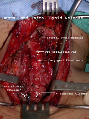 tracheal%20sleeve%201%20trach%20resect.jpg
