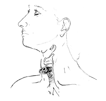 A Tracheostomy is an Opening   into the Trachea Through the Neck for Placement of a Tracheostomy Tube