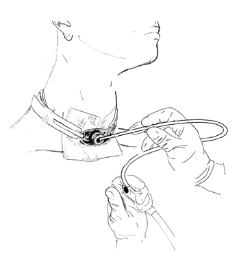 Thumb Off the Suction Control Vent